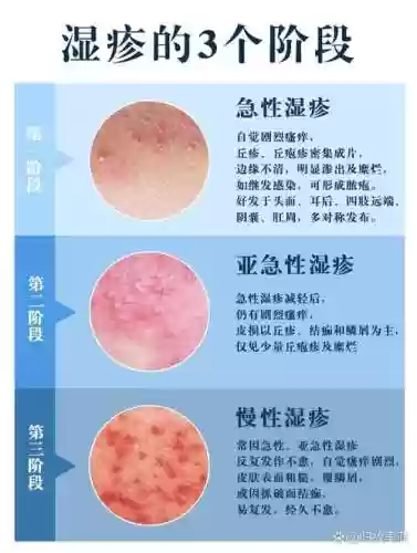 湿疹阵容插图1